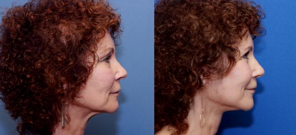 This patient underwent a face lift and neck lift with transfer of fat to restore volume and rejuvenate her skin with stem cells.